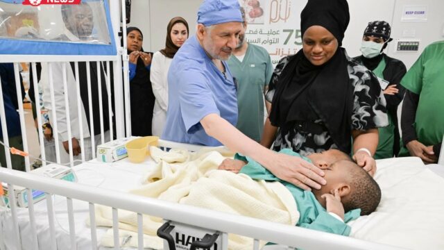 الرياض: انطلاق عملية فصل التوأم الملتصق التنزاني “لايتيينس ولوفنس”
